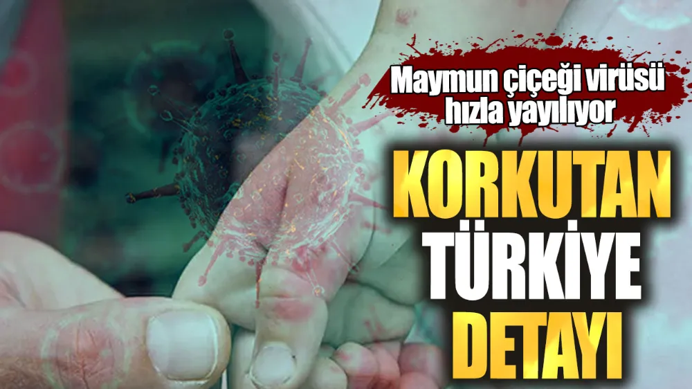 Maymun çiçeği virüsü hızla yayılıyor! Korkutan Türkiye detayı