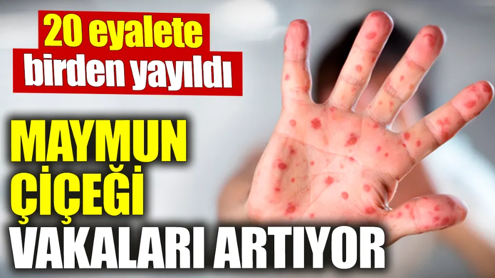 Maymun çiçeği vakası artıyor! 20 eyalete birden yayıldı